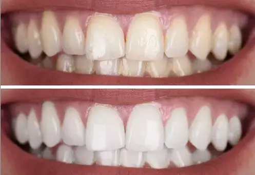 teeth2